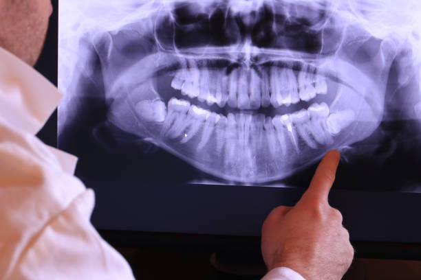 Best Emergency Wisdom Teeth Removal in Atlantis, FL